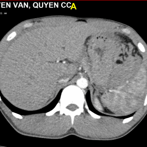 Chấn thương lách