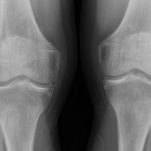 Vôi hóa sụn khớp