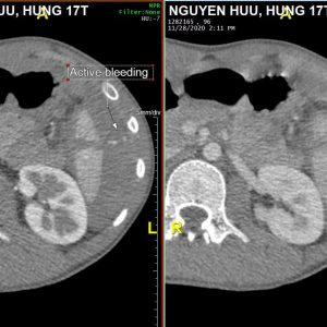 Chấn thương lách