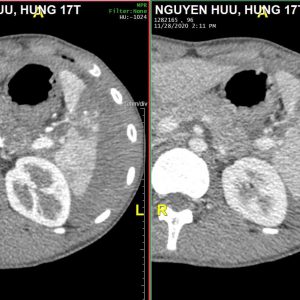 Chấn thương lách