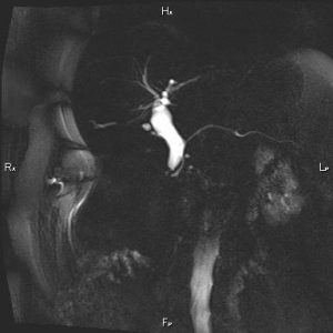 Nang ống mật chủ