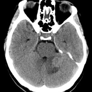 U nguyên bào tủy