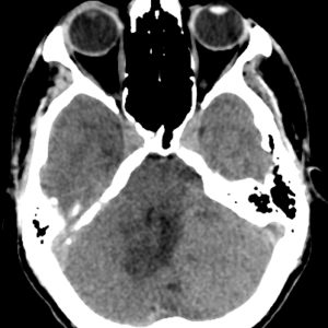 U nguyên bào tủy