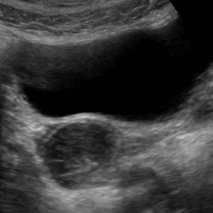 Lạc nội mạc buồng trứng