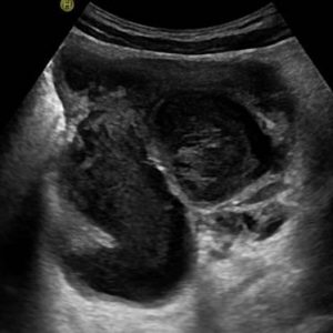 Ứ mủ vòi trứng