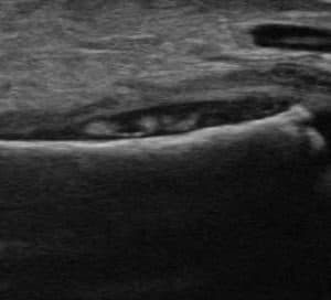 Tụ mủ dưới màng xương