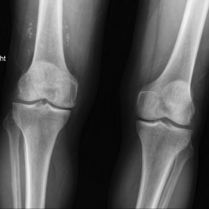 U sụn màng hoạt dịch