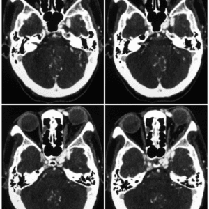 Rò động mạch cảnh xoang hang