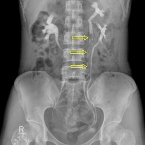 Polyp niệu quản