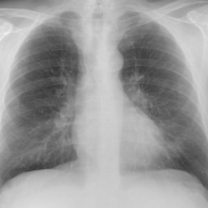 Túi thừa thực quản