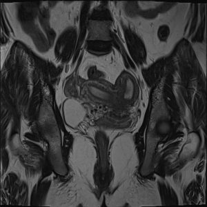 Dị dạng tử cung