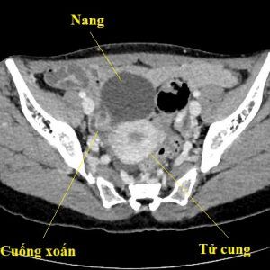 Xoắn buồng trứng