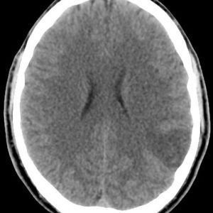 U thần kinh đệm ít nhánh