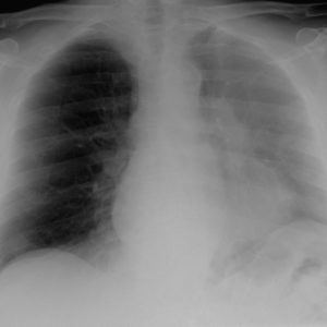 Dị vật phế quản