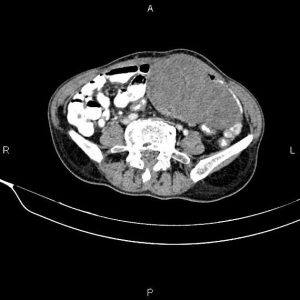 Ung thư buồng trứng