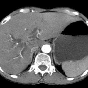 Ung thư đường mật