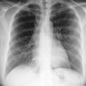 Nang tuyến phổi bẩm sinh