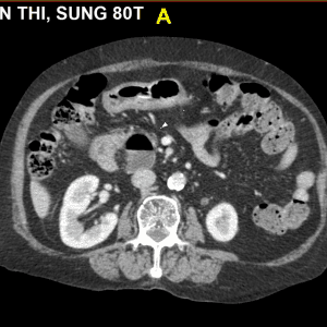 Túi thừa tá tràng