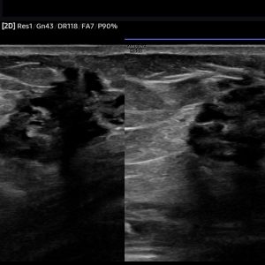 Lạc nội mạc tử cung