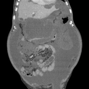 U giả nhầy phúc mạc