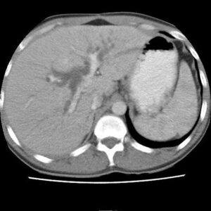 Nang ống mật chủ