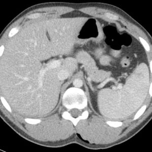 Chấn thương lách