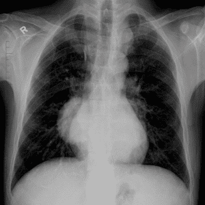 Tạo máu ngoài tủy