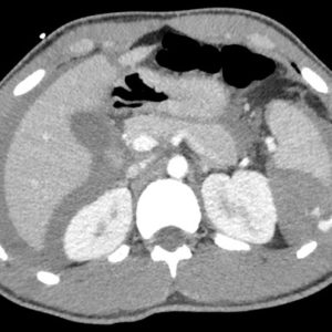 Chấn thương lách