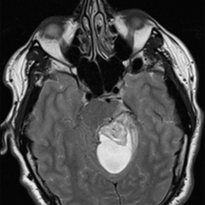 U nguyên bào mạch máu