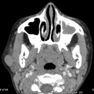 Viêm tuyến nước bọt