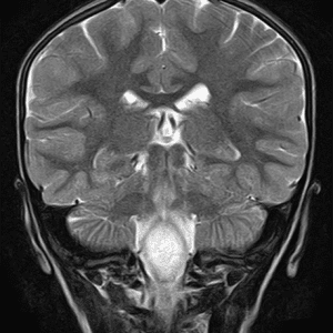 U TB thần kinh đệm