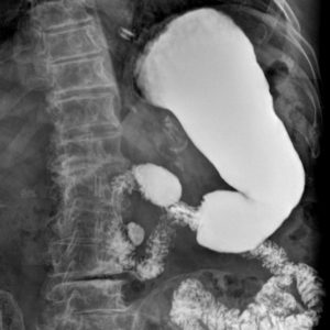 Túi thừa ống tiêu hóa