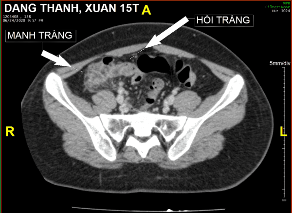 Viêm túi thừa