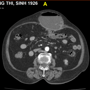 Viêm túi thừa đại tràng