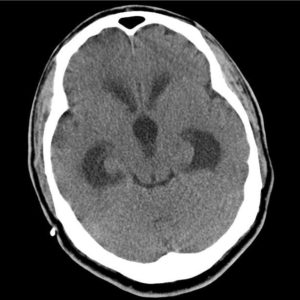 Di căn tuyến tùng