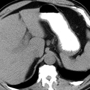 Huyết khối tĩnh mạch cửa