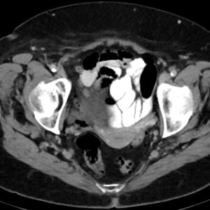 Thoát vị De Garengeot