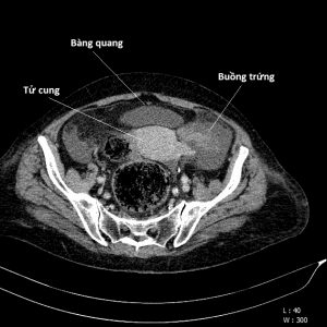 Xoắn buồng trứng