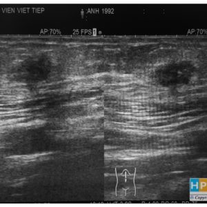 Lạc nội mạc tử cung