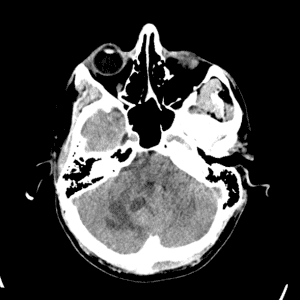 U nguyên bào tủy