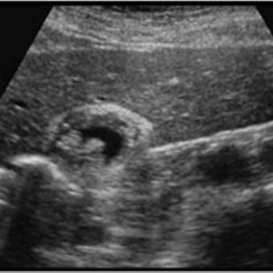 U cơ tuyến túi mật