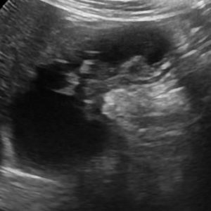 U cơ tuyến túi mật