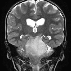 U thần kinh đệm