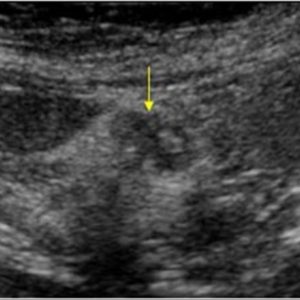 U cơ tuyến túi mật