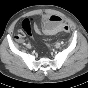 Thủng túi thừa đại tràng