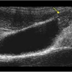 U cơ tuyến túi mật