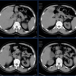 Ung thư đường mật