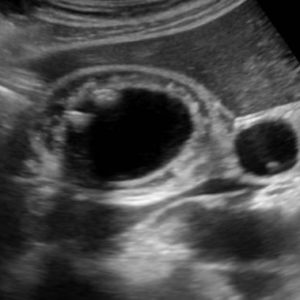 U cơ tuyến túi mật