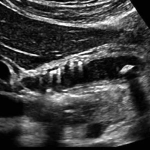 U cơ tuyến túi mật