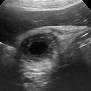 U cơ tuyến túi mật